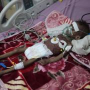 Malnourished girl Rahmah Watheeq, receives treatment at a feeding centre at Al-Sabeen hospital in Sanaa, Yemen (Hani Mohammed/AP)